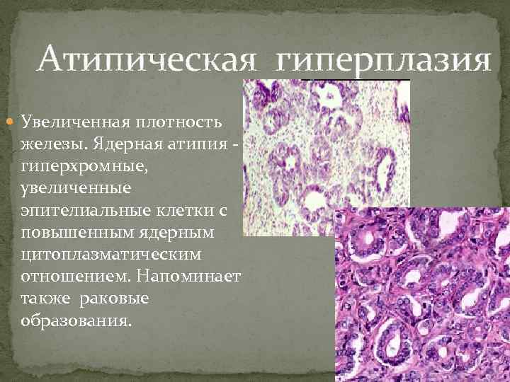 Атипическая гиперплазия Увеличенная плотность железы. Ядерная атипия - гиперхромные, увеличенные эпителиальные клетки с повышенным