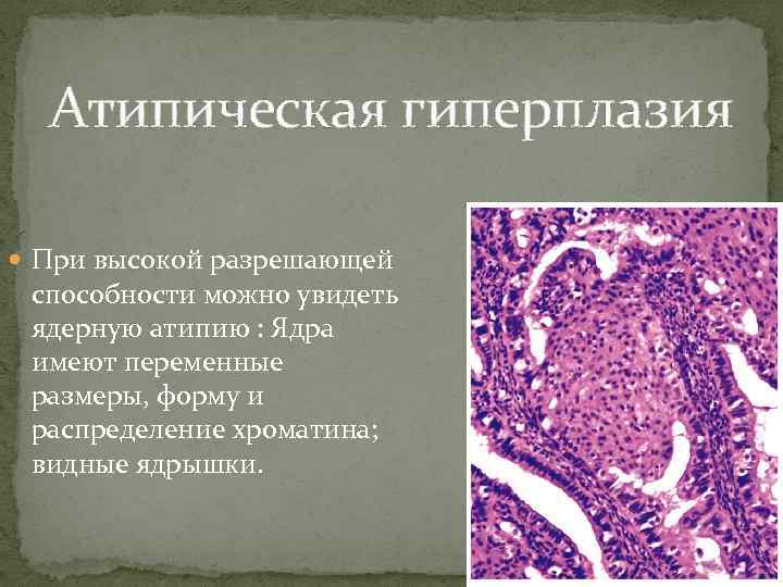 Атипическая гиперплазия При высокой разрешающей способности можно увидеть ядерную атипию : Ядра имеют переменные