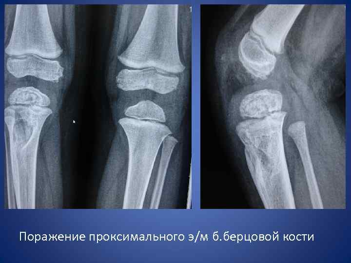 Поражение проксимального э/м б. берцовой кости 