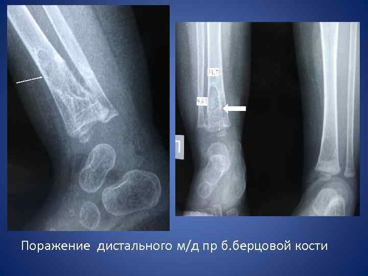 Поражение дистального м/д пр б. берцовой кости 