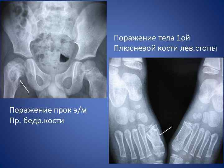 Поражение тела 1 ой Плюсневой кости лев. стопы Поражение прок э/м Пр. бедр. кости