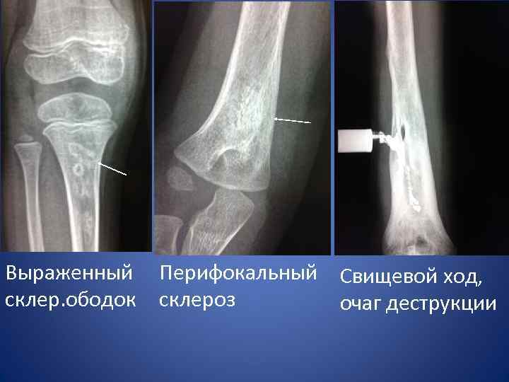 Остеосклеротические очаги в костях