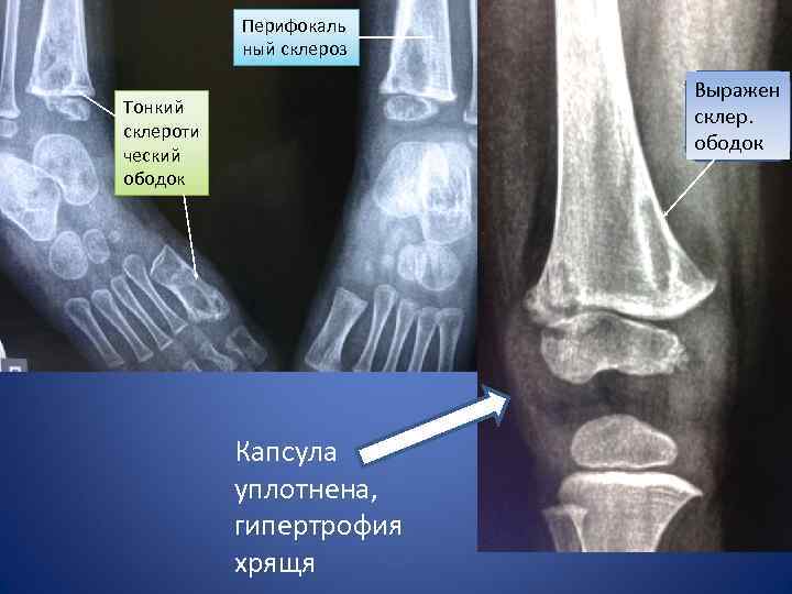 Перифокаль ный склероз Выражен склер. ободок Тонкий склероти ческий ободок Капсула уплотнена, гипертрофия хрящя