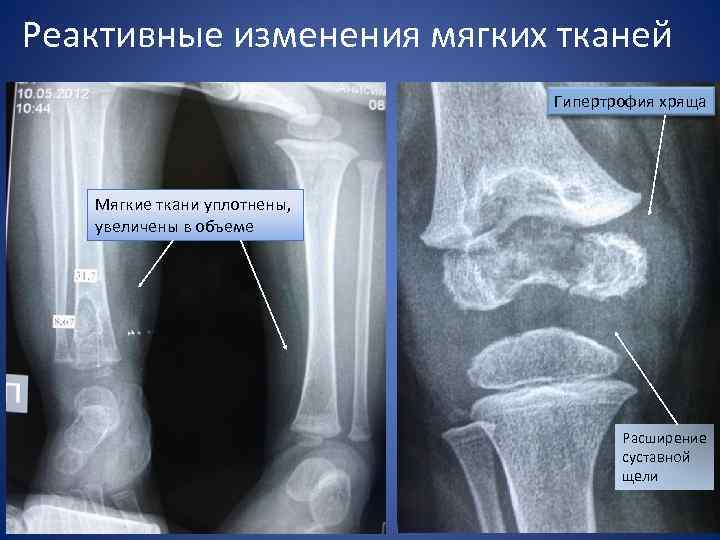 Реактивные изменения. Суставная щель на рентгене. Расширенная суставная щель. Расширение суставной щели коленного сустава. Изменение рентгеновской суставной щели.