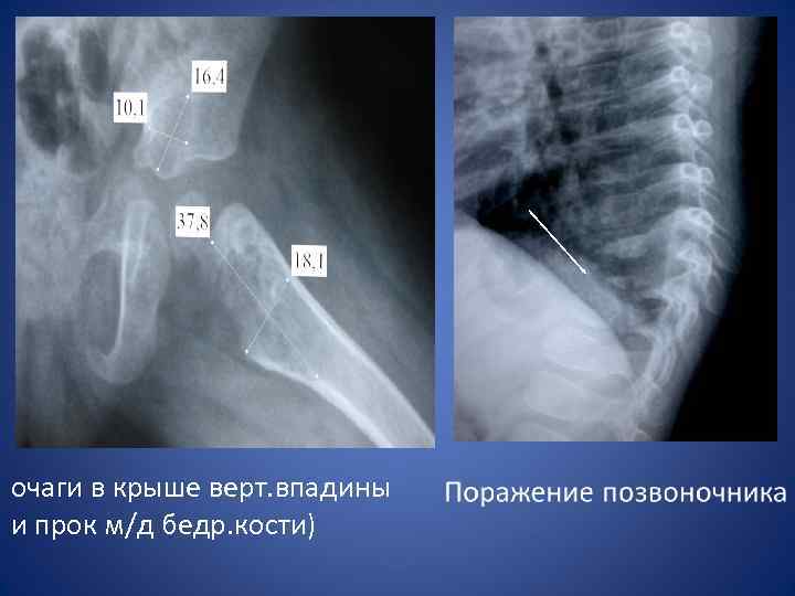 очаги в крыше верт. впадины и прок м/д бедр. кости) 