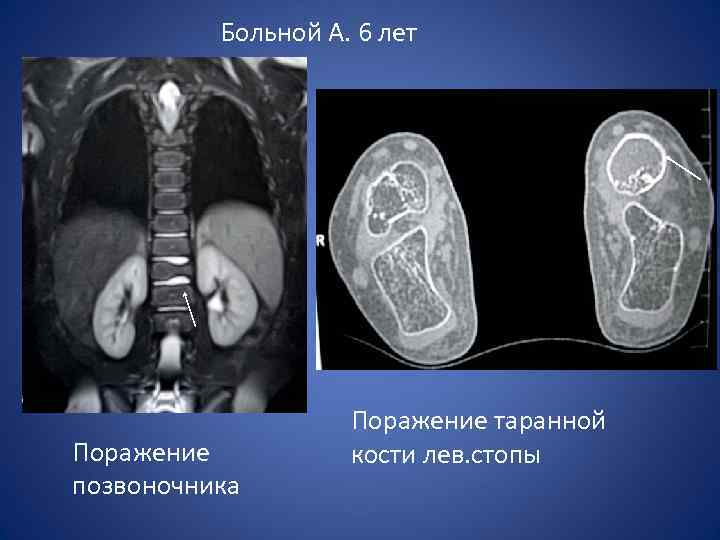 Больной А. 6 лет Поражение позвоночника Поражение таранной кости лев. стопы 