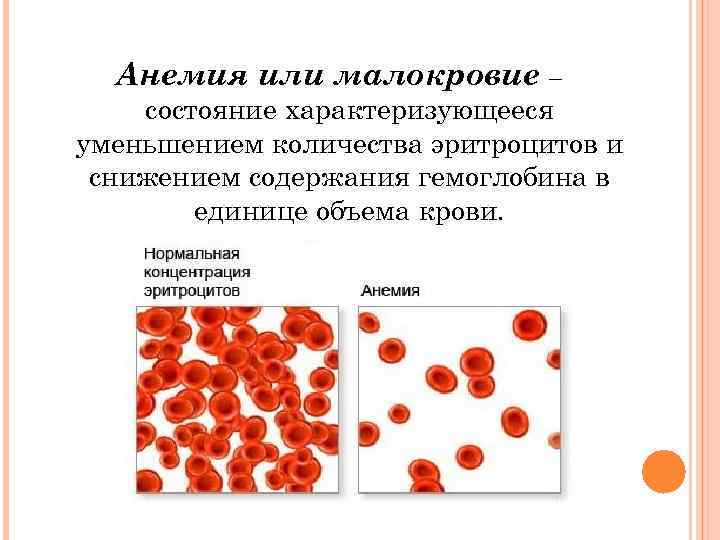 Анемия или малокровие – состояние характеризующееся уменьшением количества эритроцитов и снижением содержания гемоглобина в