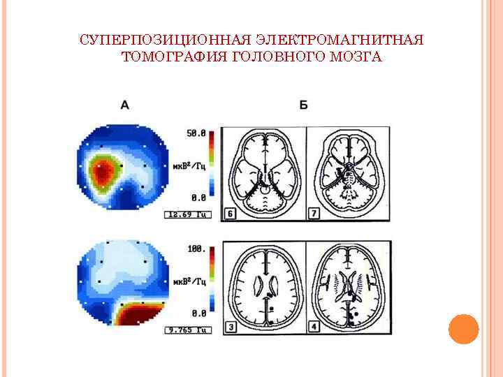 СУПЕРПОЗИЦИОННАЯ ЭЛЕКТРОМАГНИТНАЯ ТОМОГРАФИЯ ГОЛОВНОГО МОЗГА 