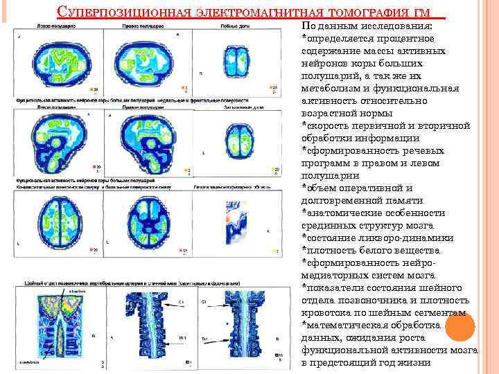 СУПЕРПОЗИЦИОННАЯ ЭЛЕКТРОМАГНИТНАЯ ТОМОГРАФИЯ ГМ По данным исследования: *определяется процентное содержание массы активных нейронов коры