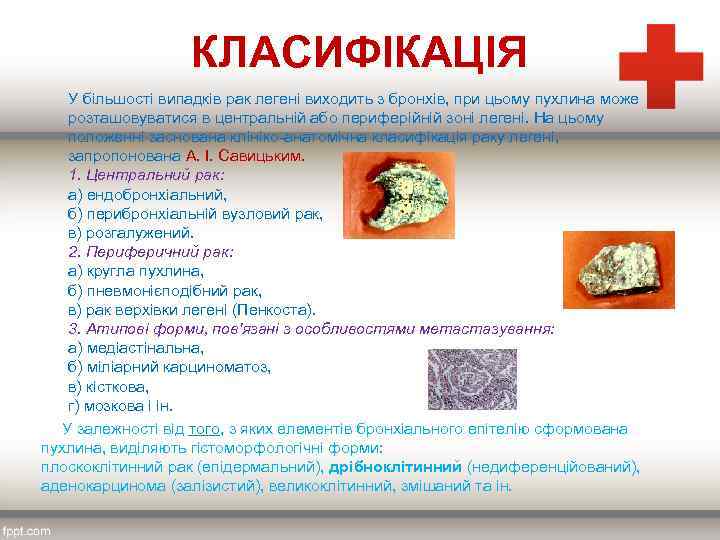 КЛАСИФІКАЦІЯ У більшості випадків рак легені виходить з бронхів, при цьому пухлина може розташовуватися