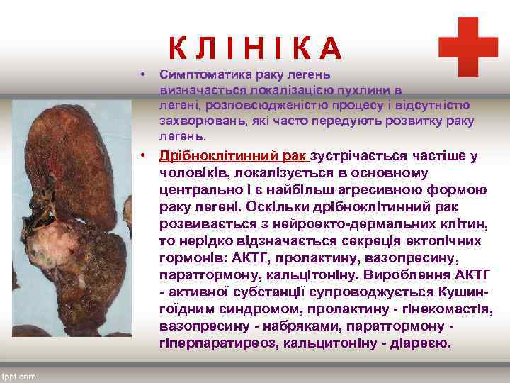 К Л І Н І К А • Симптоматика раку легень визначається локалізацією пухлини