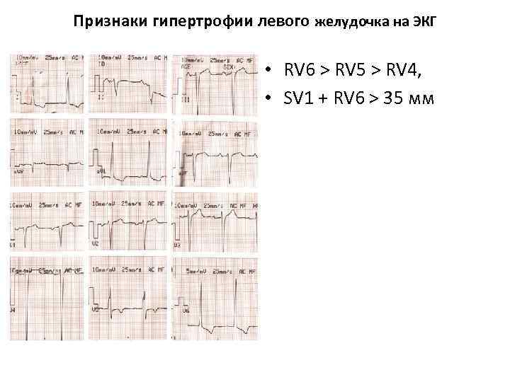 Признаки гипертрофии левого желудочка на ЭКГ • RV 6 > RV 5 > RV
