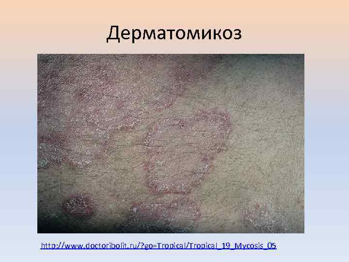 Дерматомикоз http: //www. doctoribolit. ru/? go=Tropical/Tropical_19_Mycosis_05 