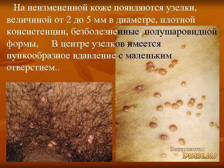 На неизмененной коже появляются узелки, величиной от 2 до 5 мм в диаметре, плотной