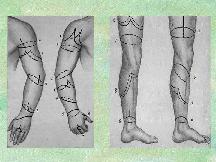Ампутация нижней конечности на уровне средней трети голени. Ампутация ноги топографическая анатомия. Ампутация бедра по Гритти-Шимановскому.