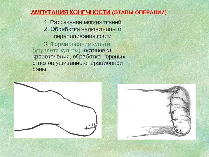 АМПУТАЦИЯ КОНЕЧНОСТИ (ЭТАПЫ ОПЕРАЦИИ) 1. Рассечение мягких тканей 2. Обработка надкостницы и перепиливание кости