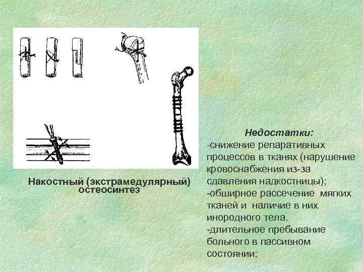 Накостный (экстрамедулярный) остеосинтез Недостатки: -снижение репаративных процессов в тканях (нарушение кровоснабжения из-за сдавления надкостницы);