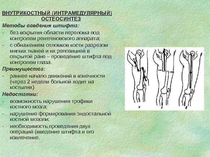 ВНУТРИКОСТНЫЙ (ИНТРАМЕДУЛЯРНЫЙ) ОСТЕОСИНТЕЗ Методы введения штифта: - без вскрытия области перелома под контролем рентгеновского