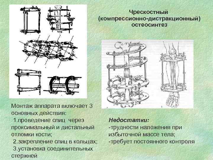 Чрескостный (компрессионно-дистракционный) остеосинтез Монтаж аппарата включает 3 основных действия: 1. проведение спиц через проксимальный