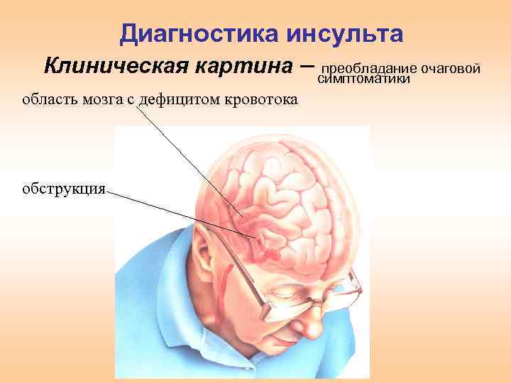 Острое нарушение мозгового кровообращения хеликс. Диагностика инсульта. Инсульт схема. Методы диагностики инсульта. Клиническая картина инсульта.