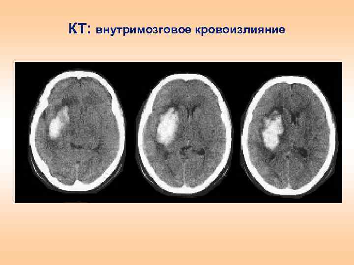 Кровоизлияние в полушарие. Мозговое кровоизлияние кт. Внутримозговое кровоизлияние мрт. Стадии внутримозгового кровоизлияния на кт. Внутримозговое и субарахноидальное кровоизлияние на кт.