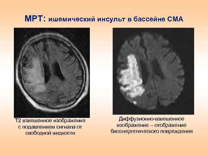 Инсульт левой средней мозговой артерии