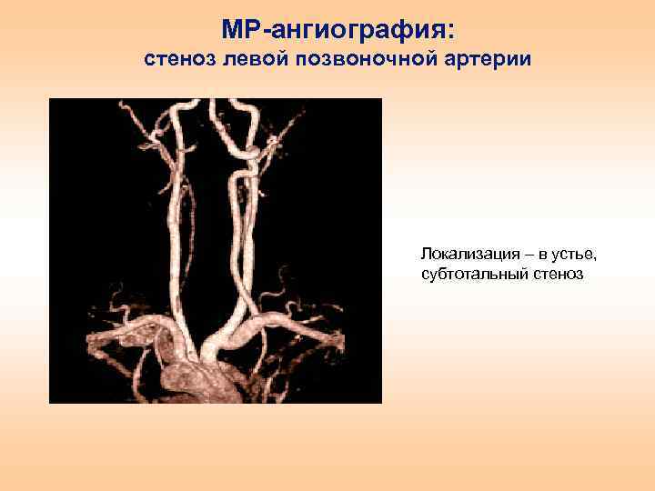 Сужение правой артерии. Стеноз устья позвоночной артерии. Стеноз правой позвоночной артерии. Ангиография позвоночной артерии. Стеноз устья правой позвоночной артерии.