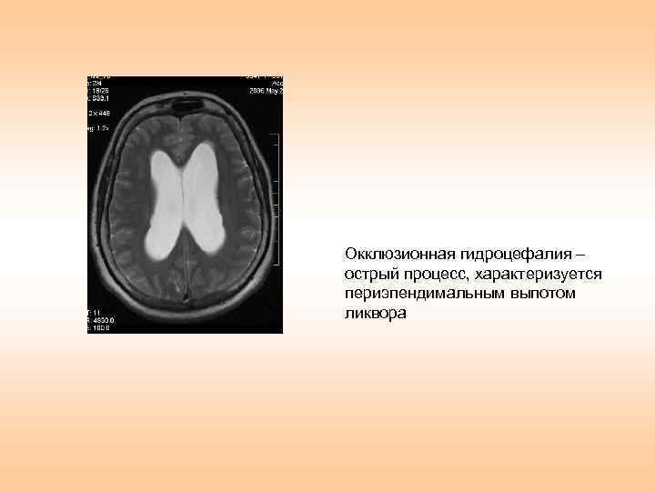 Окклюзионная гидроцефалия – острый процесс, характеризуется периэпендимальным выпотом ликвора 