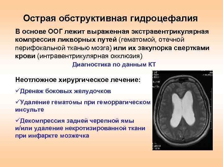 Причины гидроцефалии мозга. Наружная гидроцефалия головного мозга кт. Внутренняя обструктивная гидроцефалия. Острая обструктивная гидроцефалия. Обтурационная гидроцефалия.