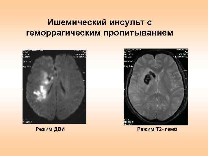 Острые нарушения мозгового кровообращения презентация