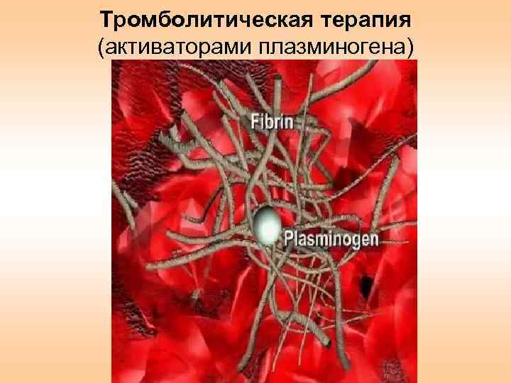 Тромболитическая терапия (активаторами плазминогена) 