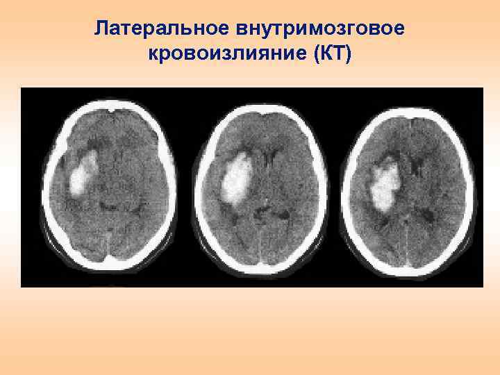 Латеральное внутримозговое кровоизлияние (КТ) 