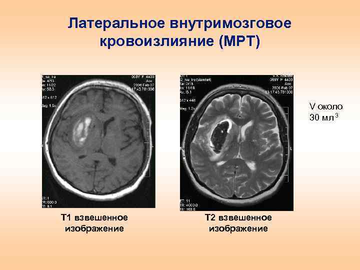 Кровоизлияние в полушарие. ОНМК по геморрагическому типу мрт. Внутримозговое кровоизлияние и ОНМК. Внутримозговое кровоизлияние мрт. Внутримозговая гематома мрт.