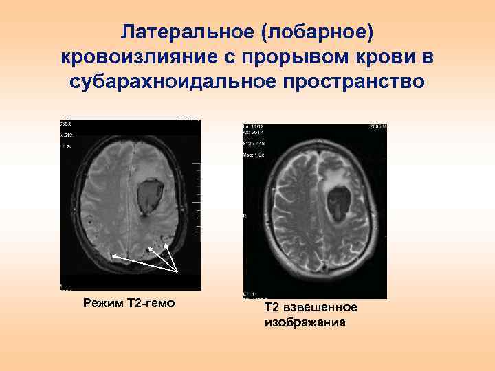 Расширение субарахноидального. Лобарное медиальное Латеральное кровоизлияние\. Диапедезное кровоизлияние в субарахноидальном пространстве. Острое Латеральное кровоизлияние в боковые желудочки.