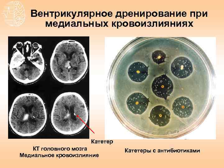 Вентрикулярное дренирование при медиальных кровоизлияниях Катетер КТ головного мозга Медиальное кровоизлияние Катетеры с антибиотиками