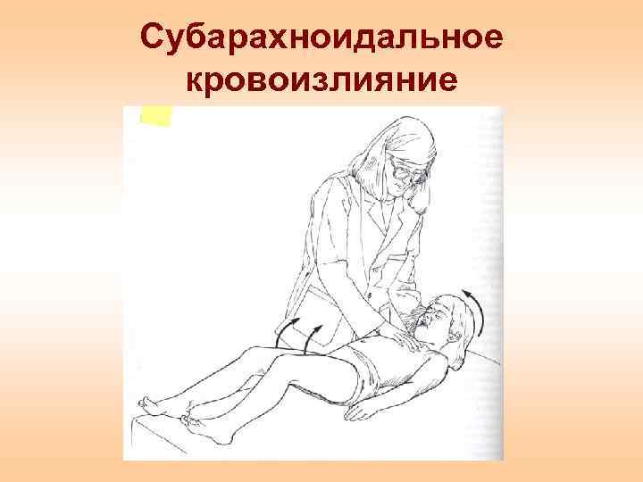 Субарахноидальное кровоизлияние 