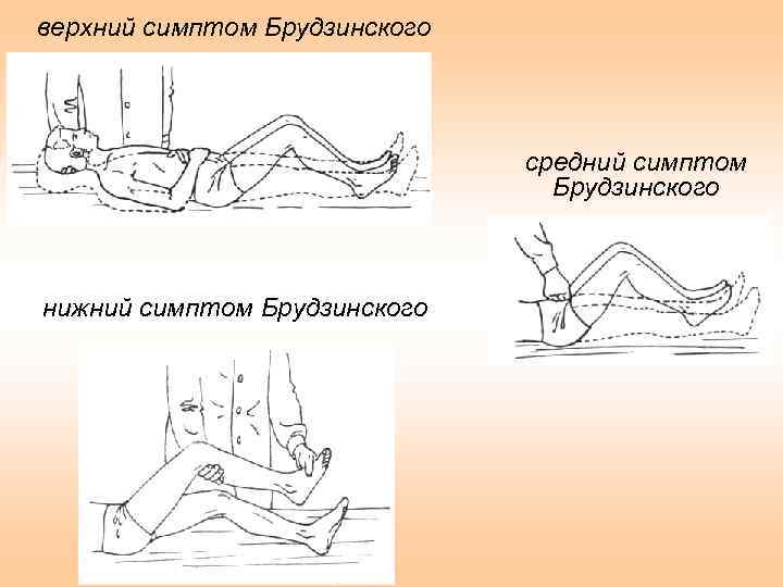 верхний симптом Брудзинского средний симптом Брудзинского нижний симптом Брудзинского 