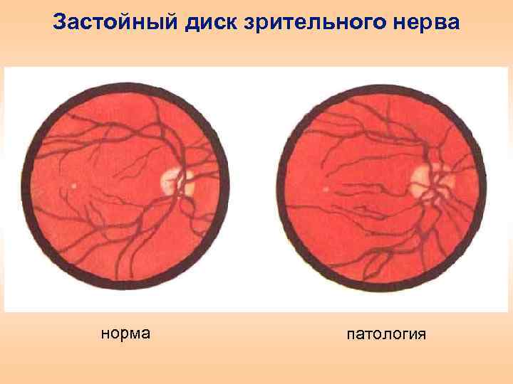 Застойный диск зрительного нерва норма патология 