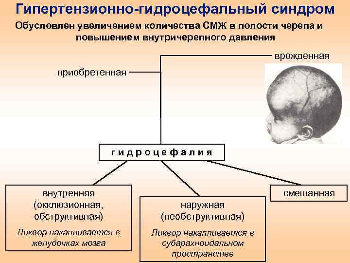 Диагноз гидроцефалии. Гидроцефалия клинические проявления. Гипертензионный симптомы у детей. Гипертензионно-гидроцефальный синдром. Клинические симптомы гидроцефалии.