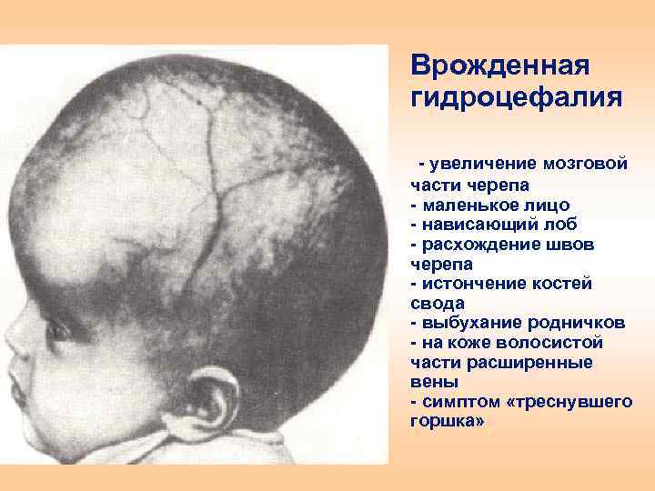 Врожденная гидроцефалия - увеличение мозговой части черепа - маленькое лицо - нависающий лоб -