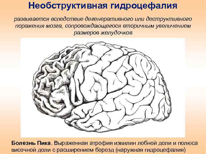 Расширение борозд мозга. Полюс височной доли. Извилины лобной доли. Атрофия лобных долей кт. Полюс лобной доли.