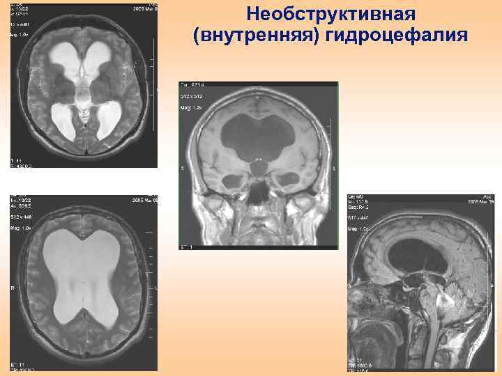 Необструктивная (внутренняя) гидроцефалия 