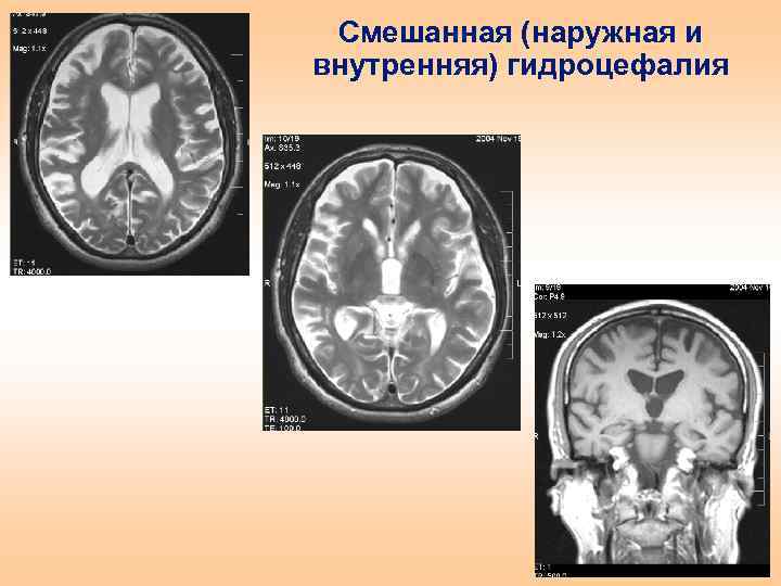 Смешанная (наружная и внутренняя) гидроцефалия 