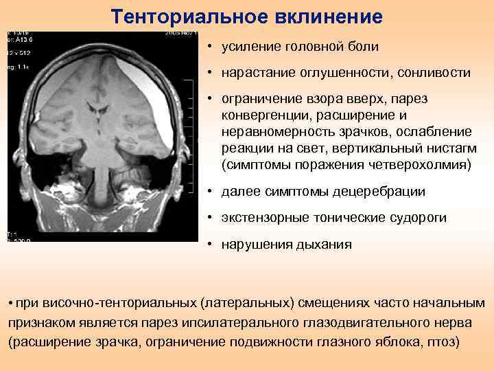Тенториальное вклинение • усиление головной боли • нарастание оглушенности, сонливости • ограничение взора вверх,