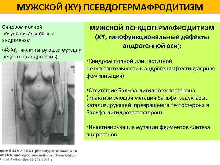 МУЖСКОЙ (XY) ПСЕВДОГЕРМАФРОДИТИЗМ Синдром полной нечувствительности к андрогенам (46 XY, инактивирующая мутация рецептора андрогенов)