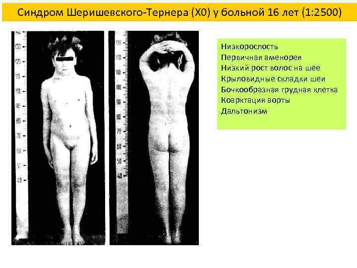 Синдром Шеришевского-Тернера (Х 0) у больной 16 лет (1: 2500) Низкорослость Первичная аменорея Низкий