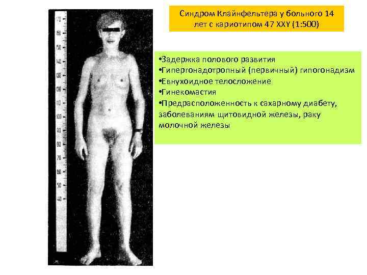 Синдром Клайнфельтера у больного 14 лет с кариотипом 47 XXY (1: 500) • Задержка