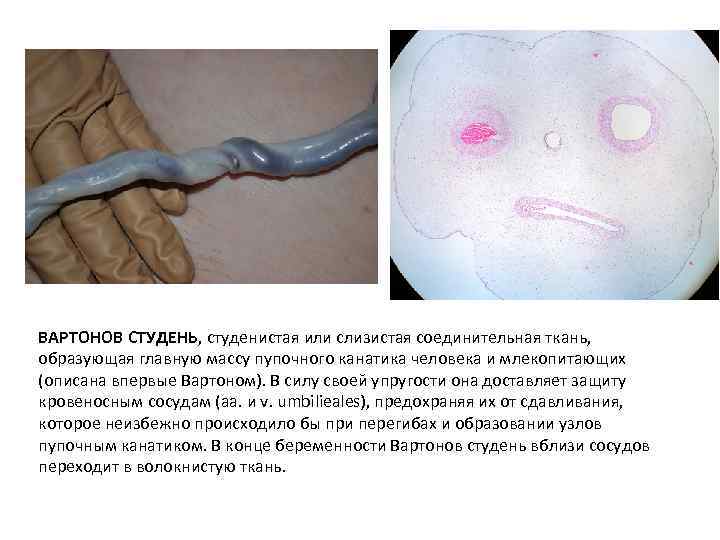 BAPTOHOB СТУДЕНЬ, студенистая или слизистая соединительная ткань, образующая главную массу пупочного канатика человека и