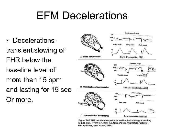 EFM Decelerations • Decelerationstransient slowing of FHR below the baseline level of more than
