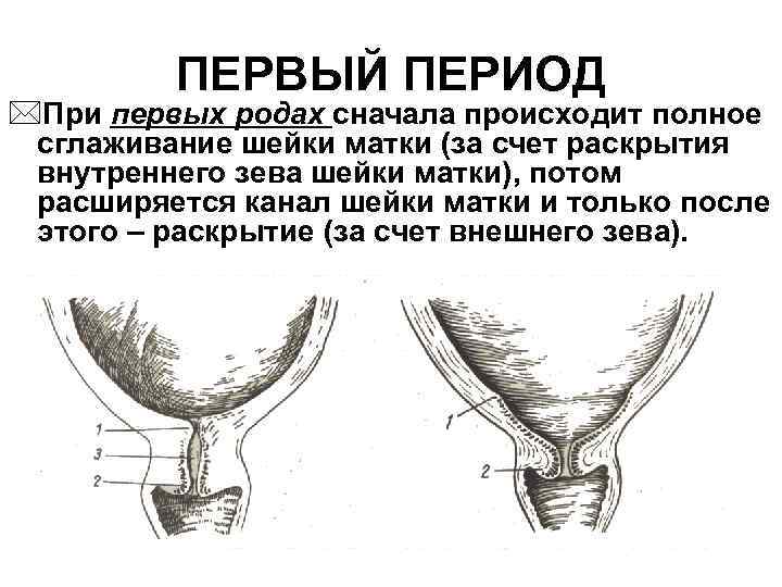 ПЕРВЫЙ ПЕРИОД *При первых родах сначала происходит полное сглаживание шейки матки (за счет раскрытия